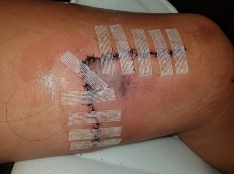 Shark Bite Or Stabbed By Fin Surfline