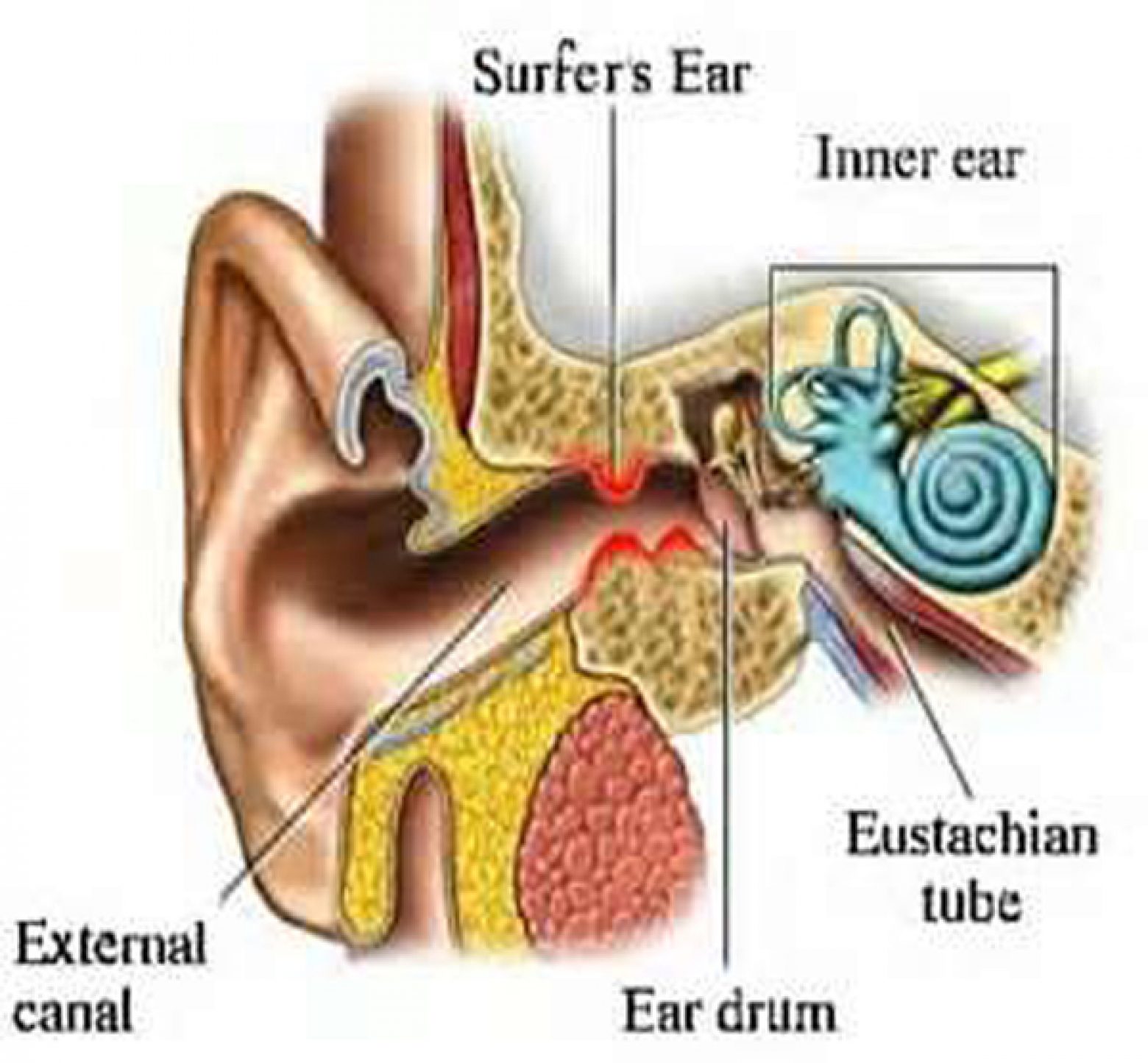 What Is Surfer's Ear? Everything You Need to Know About How to Treat Exostosis