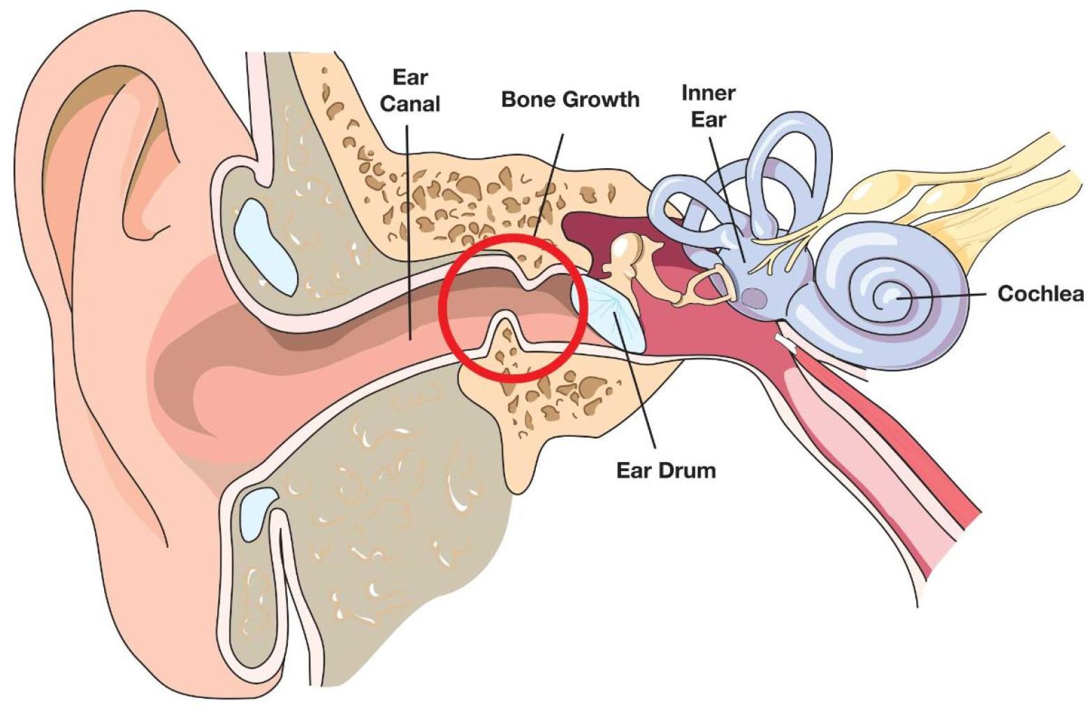 Surfer s Ear Explained Everything You Need To Know About Exostosis Surfer s Ear Explained Everything You Need To Know About Exostosis